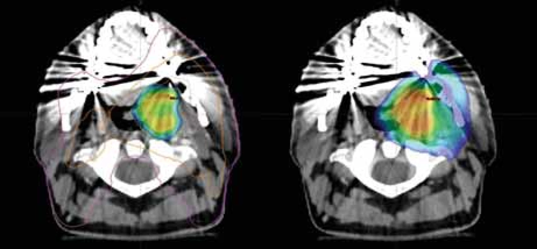 Dávkové rozložení v místě primárního tumoru; vlevo dávka 77,0 Gy dle
18F-FMISO s izodózami 77 % (oranžová) a 50 % (fialová); vpravo dávka 70,0 Gy pokrývající
oblast tumoru dle 18F-FDG; CT a MR s bezpečnostním lemem plánovacího objemu.