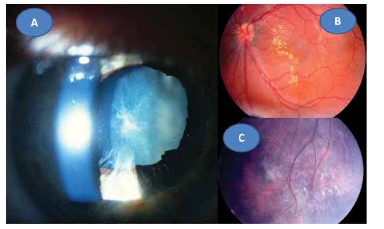 Panuveitida s kataraktou a sekundárním glaukomem vpravo v 8 letech (A) a obraz star figury při makulárním edému
(B) a progrese vaskulitidy a vitritidy v periferii vlevo (C) v době enukleace