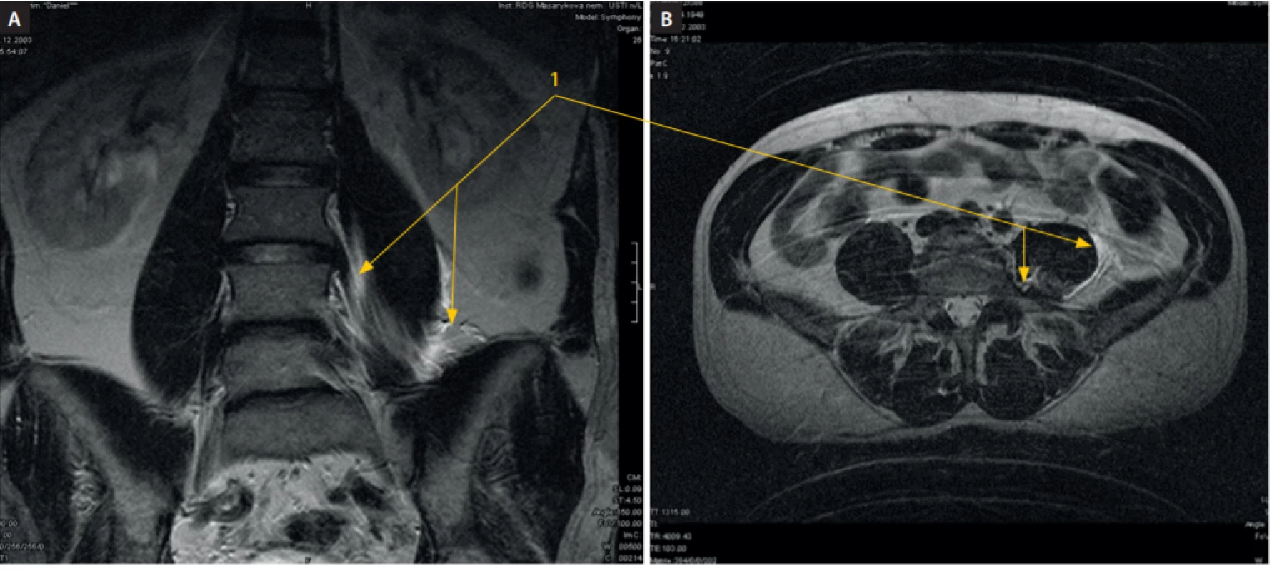 MRI dutiny břišní, vertikální řez, po podání 20 ml fyziologického roztoku cestou psoas compartment blok ve výši L2–3 vlevo a 20 ml fyziologického
roztoku cestou infrainquinálního femorálního bloku (3 in 1) vpravo. A: Na vertikálním řezu je patrná náplň psoatického a iliopsoatického kompartmentu
z mediální a laterální strany m. psoas major (1). B: Na horizontálním řezu z téhož vyšetření je patrná náplň kraniální části psoatické fascie na mediální,
dorsální a laterální části (1). Kraniokaudálním směrem byla náplň identifikovatelná na rozhraní L5–S1