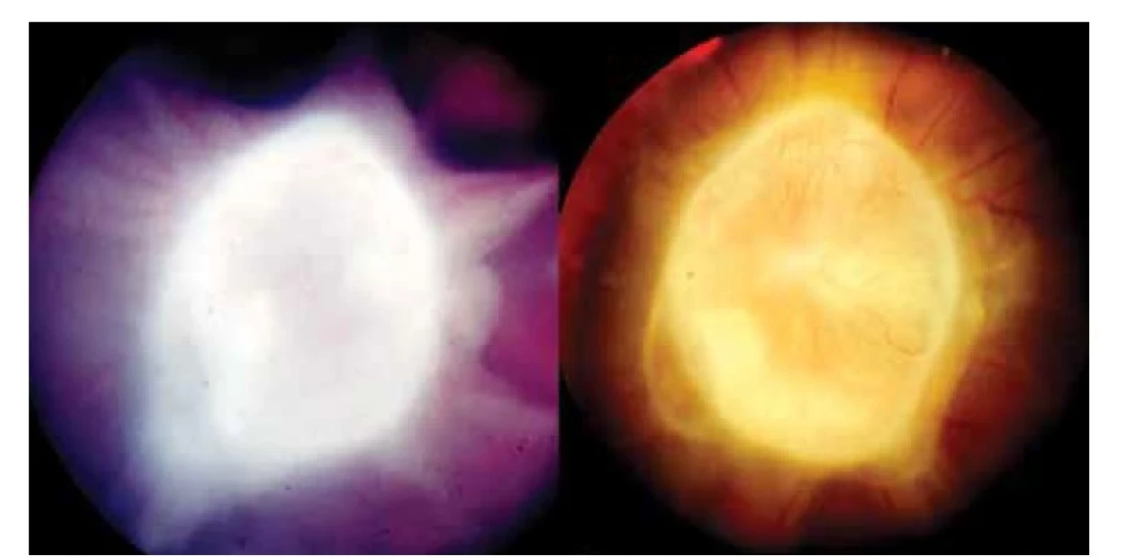 Vlevo: Cystický granulom hlavy zrakového nervu toxokarové etiologie s vitreálními
pruhy před celkovou terapií<br>
Vpravo: Cystický granulom hlavy zrakového nervu toxokarové etiologie s  kapilárami na
jeho povrchu půl roku po kombinované léčbě