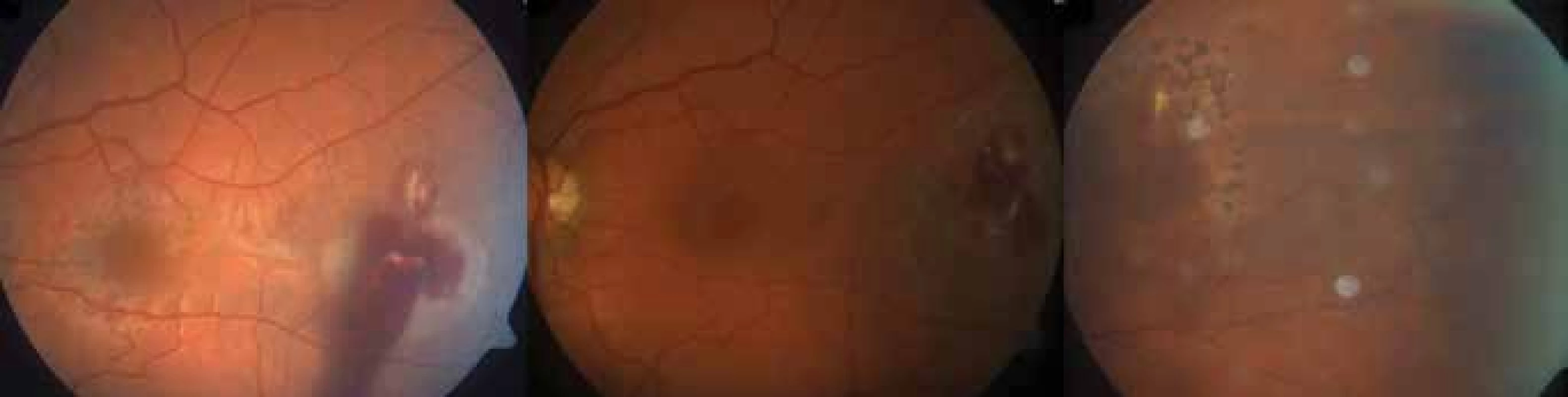 Patient no. 16 – intraocular finding before procedure and development of scar after extraction of IOFB and
endo laser treatment