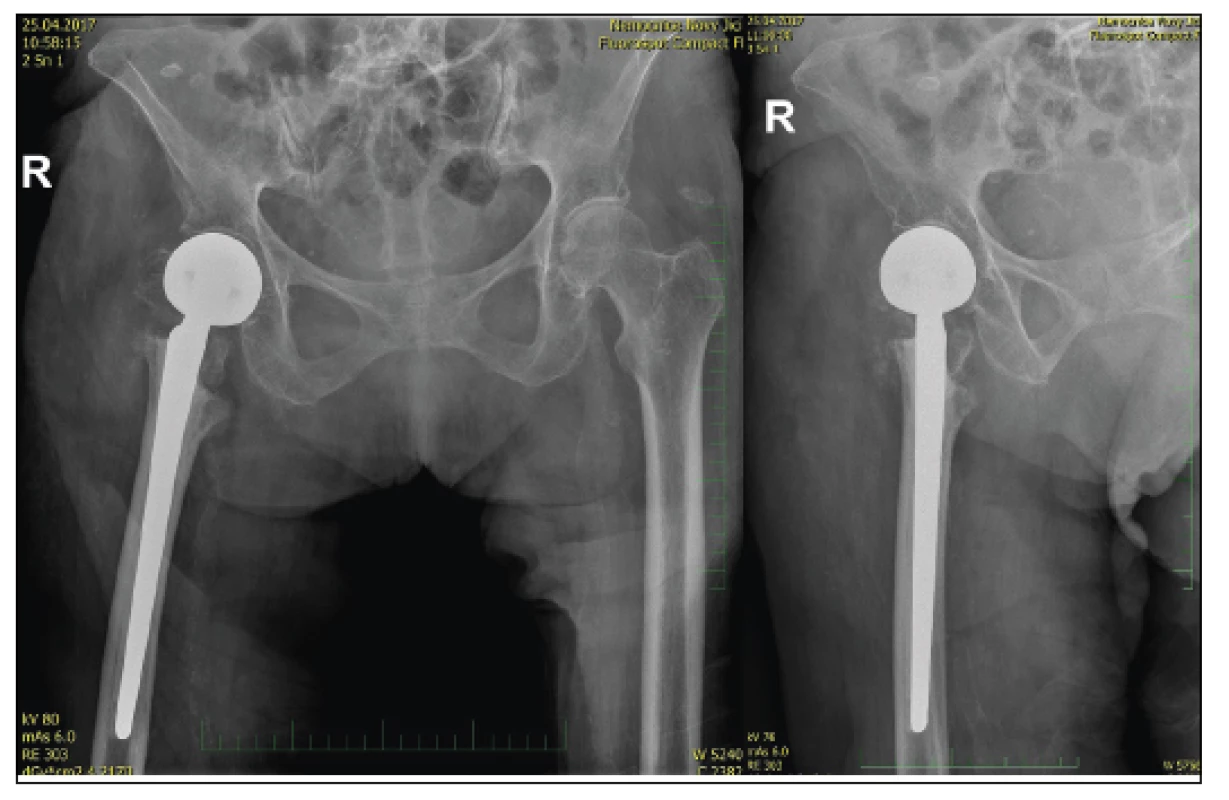 87-year-old female with pathological fracture of the trochanteric
massive, control X-ray after implantation of total joint endoprosthesis
with the Centrament stem