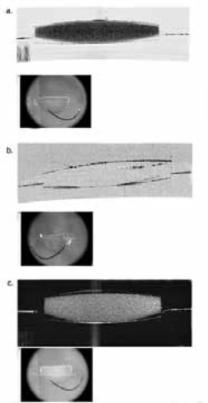 Cross-sections with the aid of anterior segment
OCT in vitro – a. homogeneous light dispersion (“scattering
effect”) on explanted IOL, b. disappearance of light
dispersion on dried IOL and c. light dispersion on rehydrated
IOL, which demonstrates that this concerns hydrophilic
material