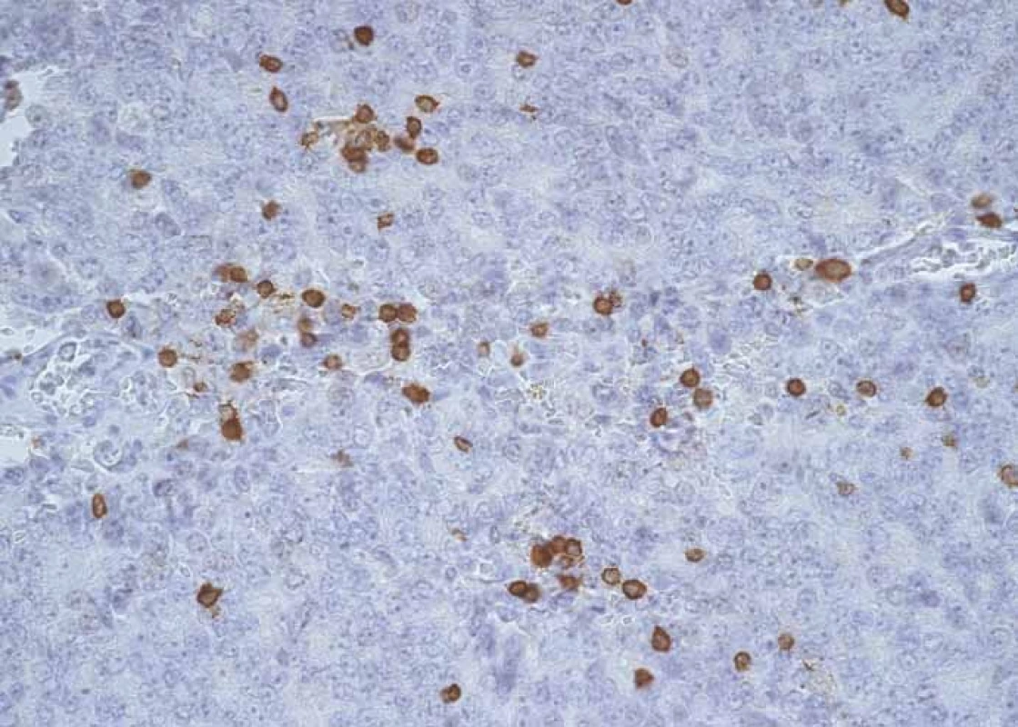 CD3+ lymphocytes infi ltrating prostate cancer structures.