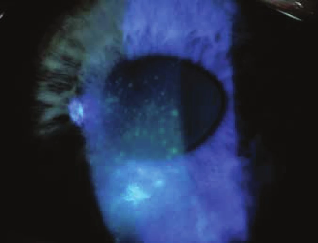 Corneal epitheliopathy in sicca syndrome