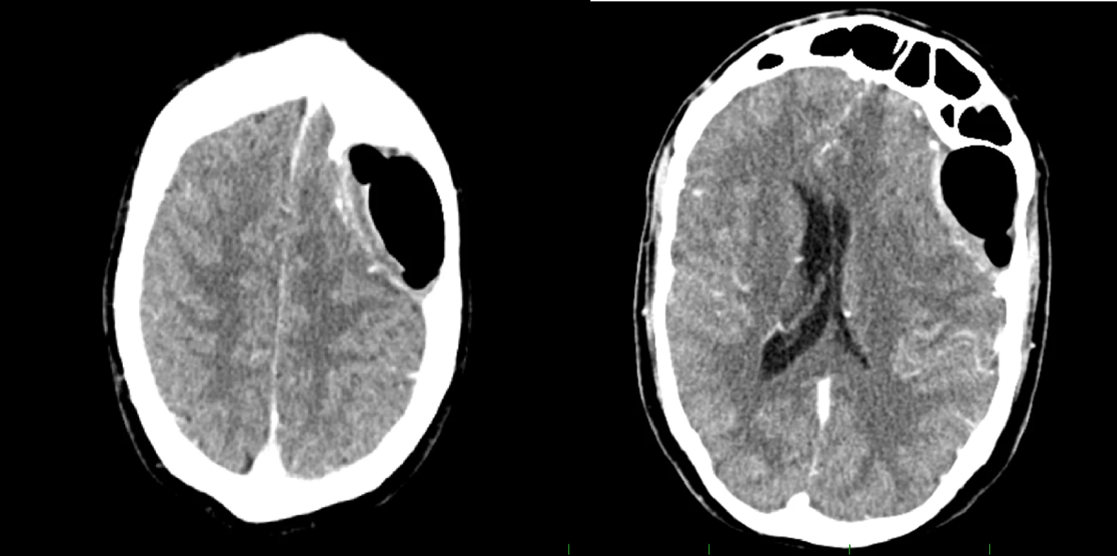 Postoperative CT scan with contrast medium showing regression of finding.<br>
Obr. 3. Pooperační CT vyšetření s kontrastní látkou ukazující regresi nálezu.


