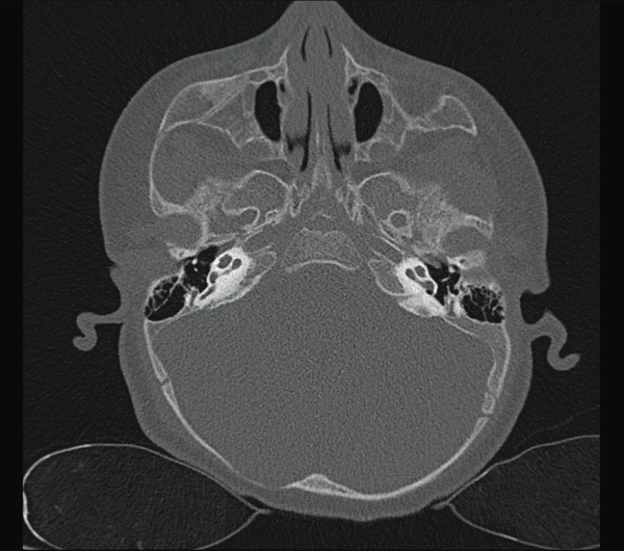 Mondiniho malformace kochley.<br>
Fig. 4. Mondini malformation of kochlea.