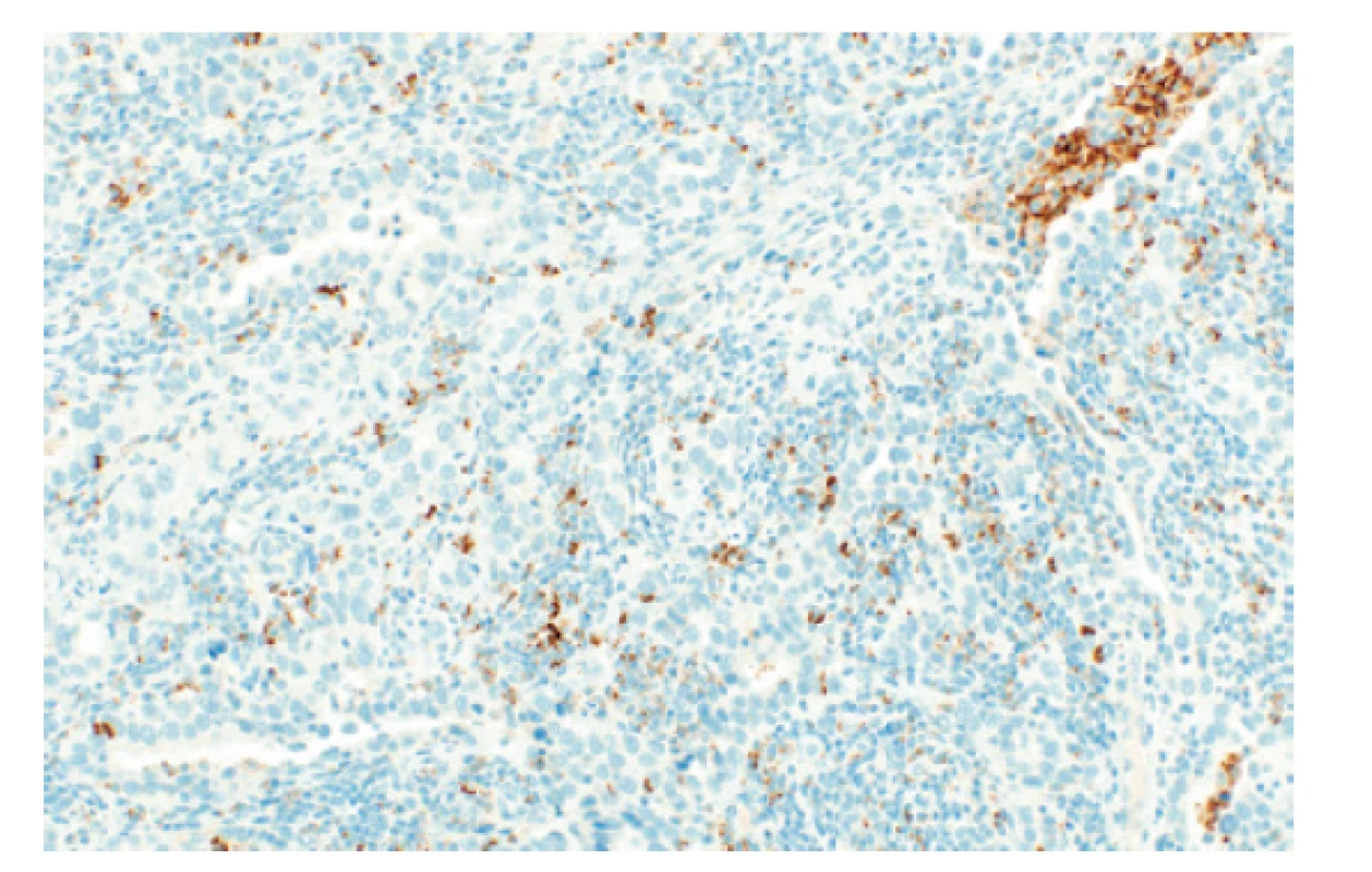 Stanovení IC v invazivním uroteliálním karcinomu pomocí imunitního
skóre (IC). Hodnotí se pozitivita zánětlivých elementů v oblasti nádoru
(stroma i nádorový epitel). Vyšetření je pozitivní s ≥ 5 % plochy nádoru infiltrované
PD-L1 pozitivními zánětlivými elementy. (Imunohistochemie PD-L1,
SP142, zvětšení 200x).