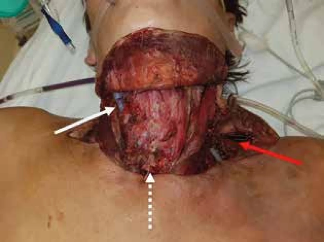 St.p. príjme na KHCH - st.p. nekrektómií s odstránením podkožia, páskových svalov a obnažením krčného priebehu trachey, bielou šípkou označený mediastinálny drén, bielou prerušovanou šípkou označená tracheotómia, červenou šípkou označená oblasť priebehu ľavého plexus brachialis <br>Fig. 3: Patient after admission to the thoracic surgery department, after necrectomy of the neck space with subcutaneous tissue and infrahyoid muscles removal, mediastinal drainage is marked by the white arrow, tracheotomy is marked by the white dashed arrow and left plexus brachialis by the red arrow