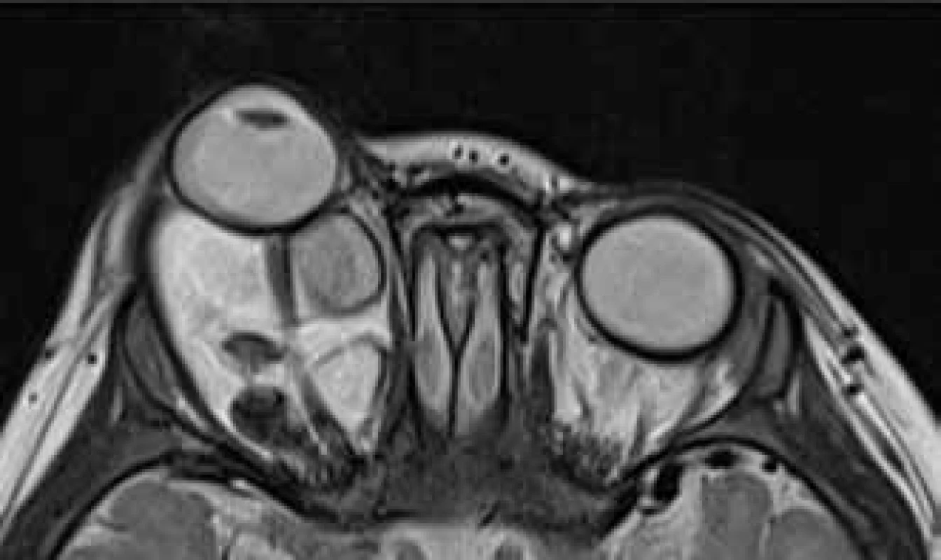 MRI vyšetření v 10. měsíci věku s patrnou protruzí
pravého bulbu a napnutím optického nervu