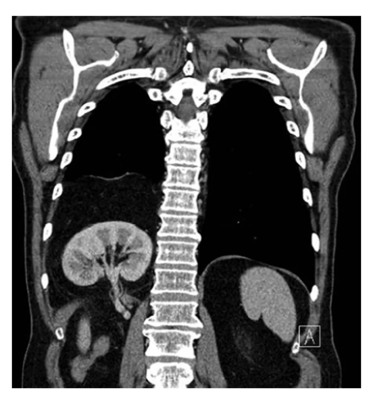 Nativní CT hrudníku a břicha jasně patrná
brániční kýla<br>
Fig. 3. CT scan of cheat and abdomen, clearly evident
diaphragmatic hernia
