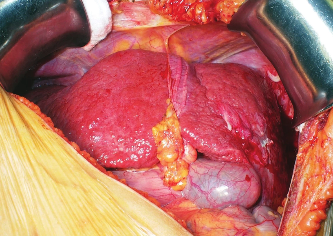 The situs inversus cirrhotic liver of the recipient before
explantation