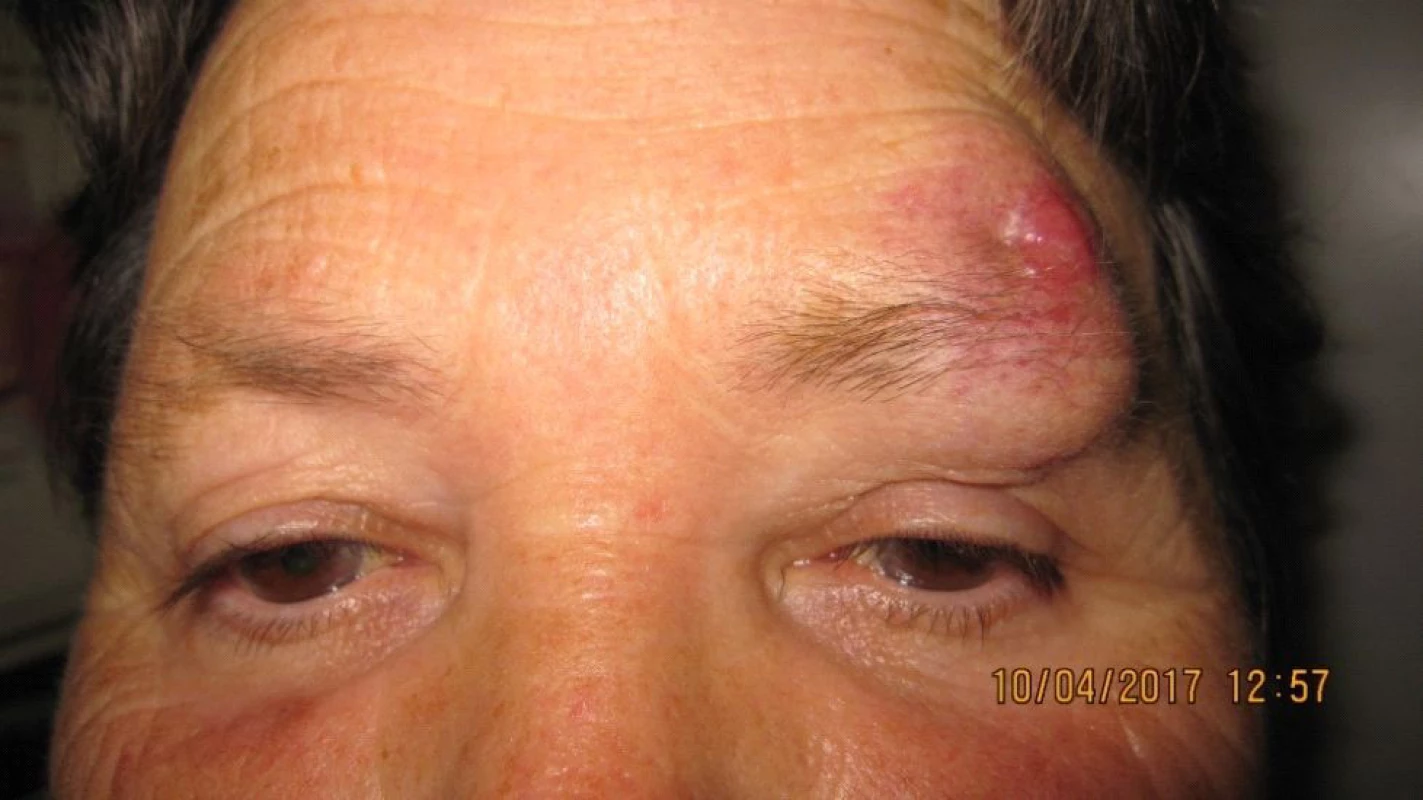 Clinical findings Patient 2 after repeated excisions in upper
eyelid and supercilium due to “oedema”