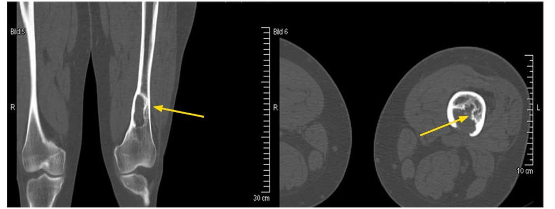 Osteolytické ložisko ve femuru narušující kortikalis. Snímek zapůjčil pro tuto publikaci prof. Claus Doberaurer z Gelsenkirchenu, Německo