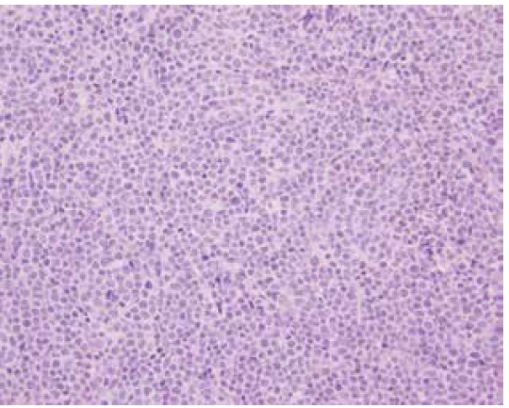 B-lymfom – základní barvení hematoxylin eozin,
400x zvětšeno<br>
Fig. 6. B-lymphoma – hematoxylin and eosin stain enlarged,
400 times