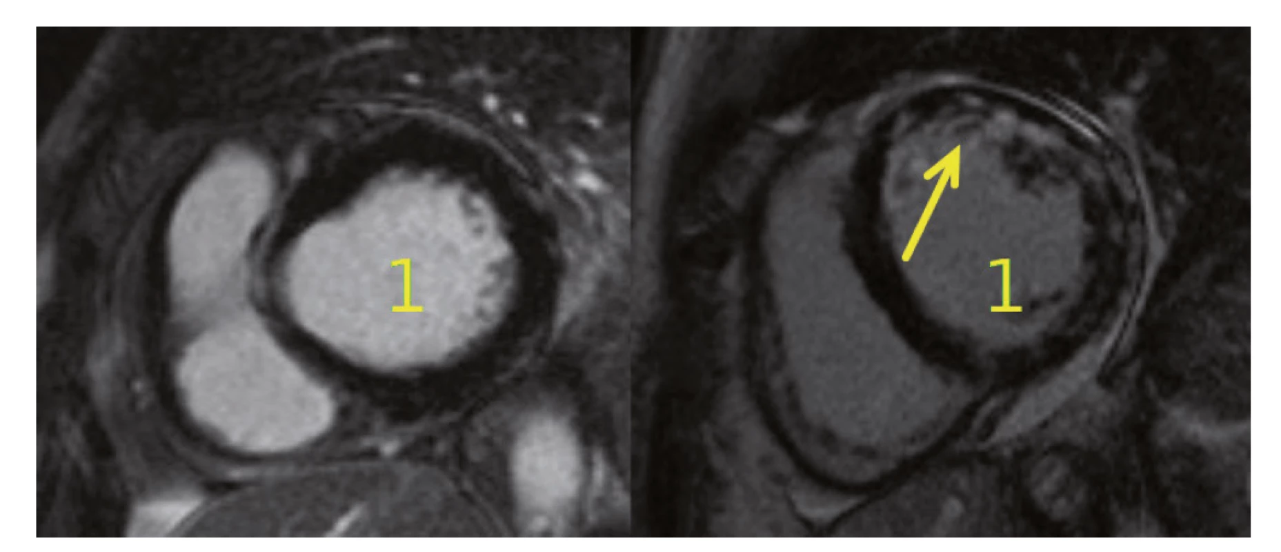 MR srdce u pacientek s MPA. Na obrázku vlevo je normální nález zjištěný u naší pacientky po podání cyklofosfamidu,
vpravo je viditelné postižení myokardu při MPA (dilatace levé komory (1) s okrskovitou opacifikací stěny LK v bazálních a středních
segmentech s převahou mid-wall lokalizace (šipka)