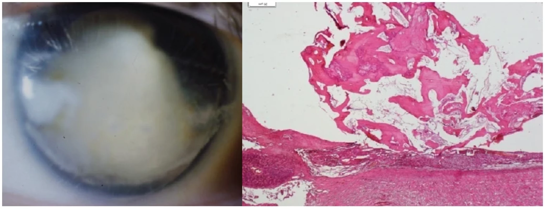 Vlevo: Ftíza bulbu po toxokarovém zánětu
Vpravo: Osifikovaná cysta po hlístu v cévnatce, HE, zvětšení 20x