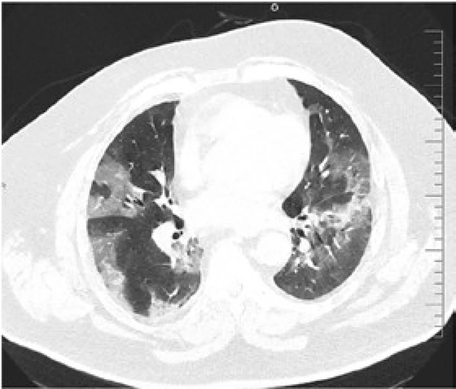 HRCT plic s obrazem odpovídajícím oboustranné virové pneumonii, bez přesvědčivých známek bakteriální superinfekce. Nález odpovídá plicnímu postižení při COVID-19 s rozsahem postižením plicního parenchymu v úrovni 30–40 %.
