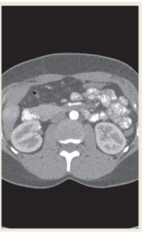 CT angiografie břicha (snímky použity s dovolením
ZRIR IKEM).<br>
Fig. 3. Abdominal CT angiography (images used with permission
from ZRIR IKEM).