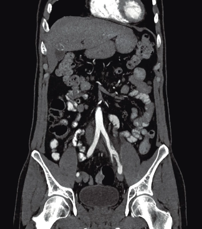 CT angiografie, koronární rekonstrukce disekované
společné až vnější ilické tepny vlevo