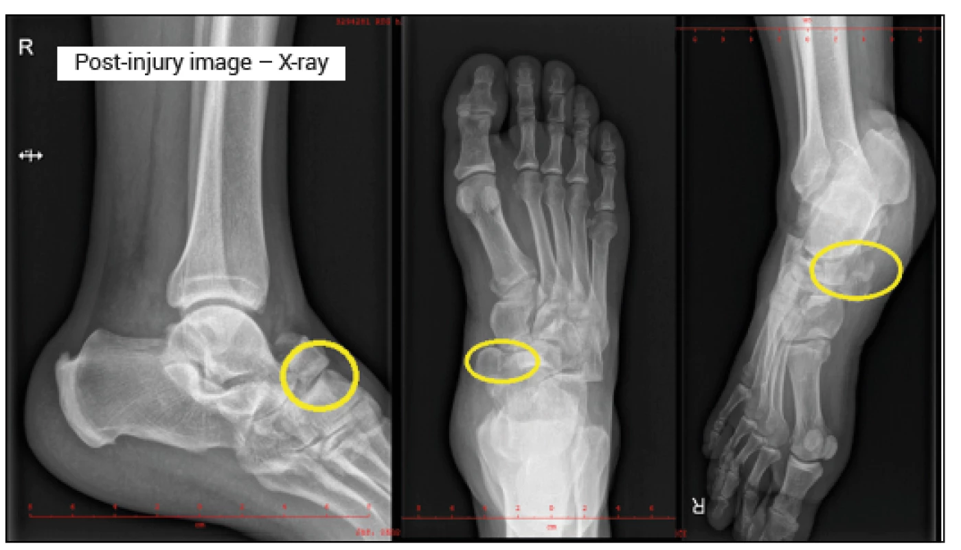 Post-injury input X-ray image (Source: Sedlář Archive)