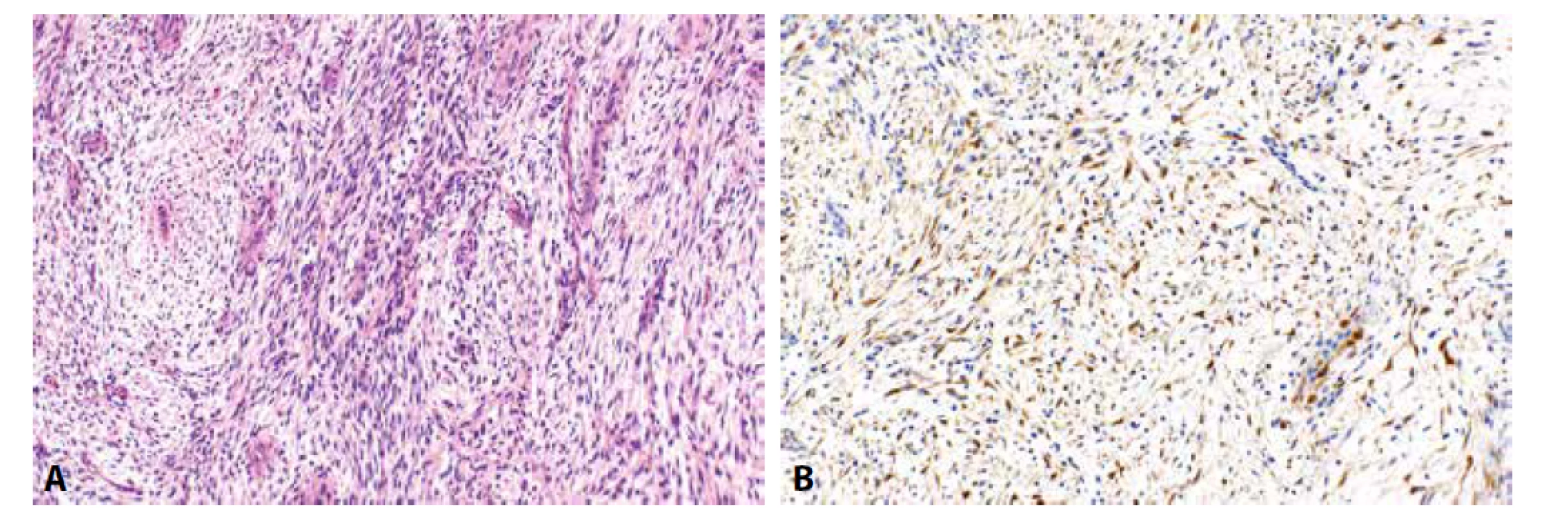 Zánětlivý myofibroblastický nádor (5A, HE, 200x). Nádorové buňky jsou pozitivní při průkazu ALK (5B, 200x).