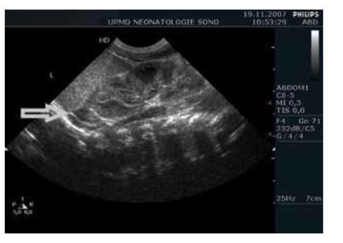 Sonografické zobrazení levé ledviny a nadleviny (šipka)
u nezralého novorozence (26. týden), nález je bez patologie
