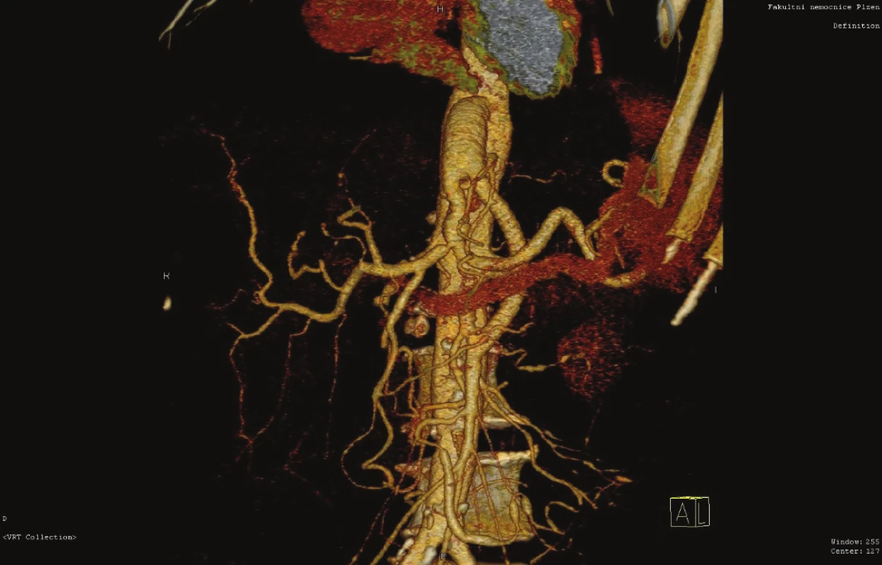 Antegrádní aorto-mezenterický/trunkální protetický
bypass (CT AG)<br>
Fig. 9: Antegrade aorto-mesenteric/trunk bypass (artificial
graft) (CT AG)