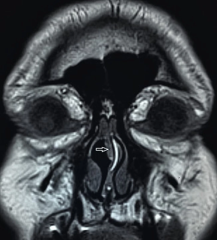 MR vyšetření, koronální rovina, T1 vážené sekvence.
Šipkou označeno ztluštění sliznice (REAH) oblasti olfactory cleft
vpravo paramediálně.