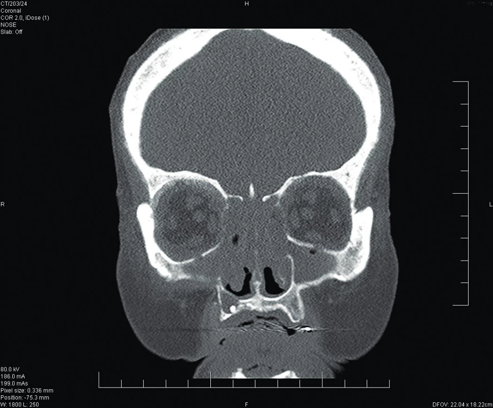 CT předoperačně, zaměřeno na nos a vedlejší nosní
dutiny (koronární projekce).