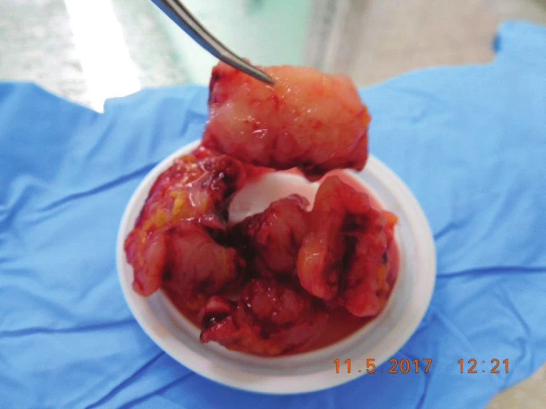 Tumor masses removed during surgery, in cut whitish,
crumbly, with no case