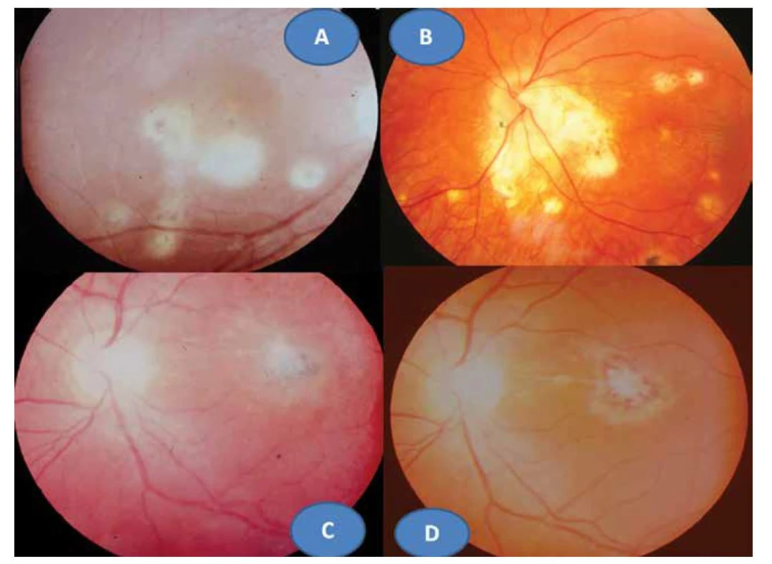 Rekurentní retinochoroiditida s mnohočetnými satelitními ložisky (akutními i jizevnatými) a CME (A), Jensenova forma rekurentní
retinochoroiditidy se satelitními ložisky(B), exacerbace retinochoroiditidy s vitritidou (C), zklidnění zánětu s atrofizací ložiska (D)
