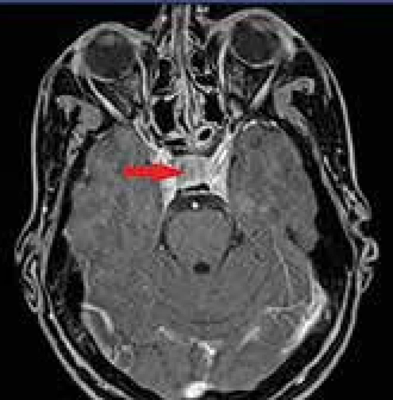 Pooperačné MRI vyšetrenie (axiálny rez)
s nálezom rezidua makroadenómu hypofýzy
veľkosti 14 × 14 × 7 mm
