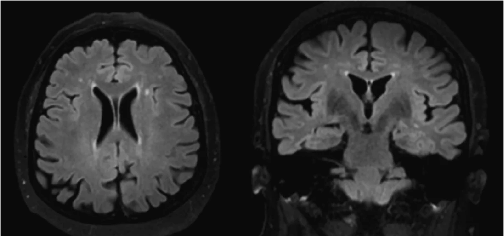 Kontrolné MRI vyšetrenie mozgu (po 4 mesiacoch) odhaľuje regresiu prejavov difúznej leukoencefalopatie (vľavo koronárny rez, vpravo axiálny rez; FLAIR sekvencia)