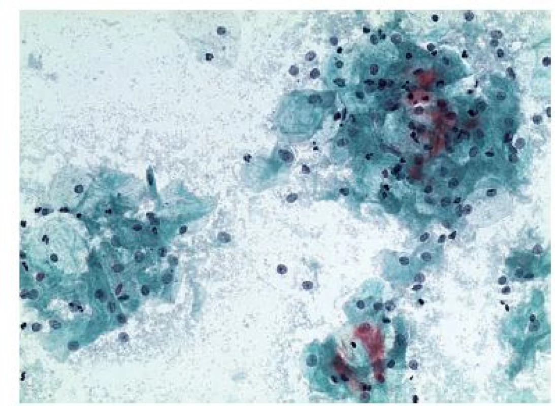Cytogram generačního období - sekreční fáze. 20. den cyklu. V pozadí
hojné laktobacily. Mírná cytolýza. Převaha cyanofi lních intermediárních
buněk. Papanicolaou, 200x