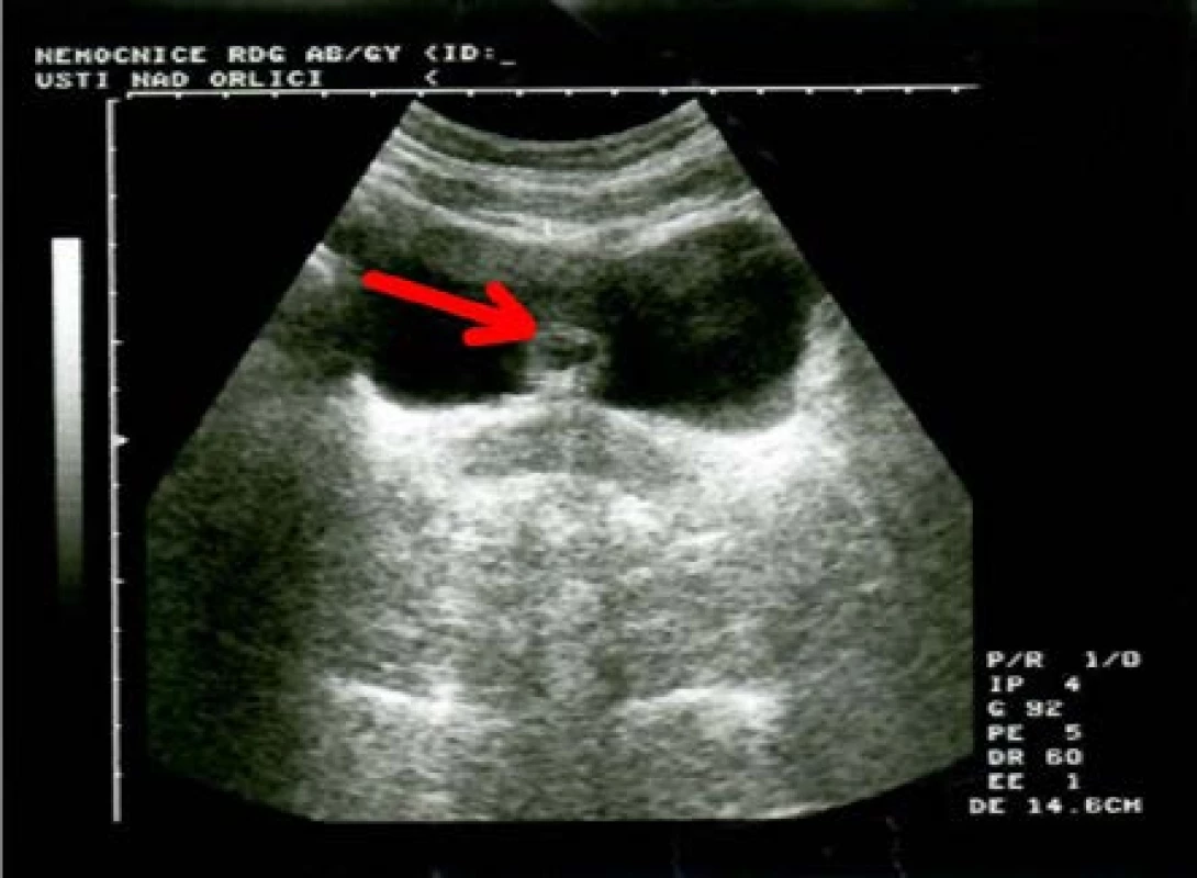 Ultrazvuk – anechogenní cystický útvar na
zadní stěně močového měchýře<br>
Fig. 1. Ultrasound – anechoic cystic form on the
bladder back wall