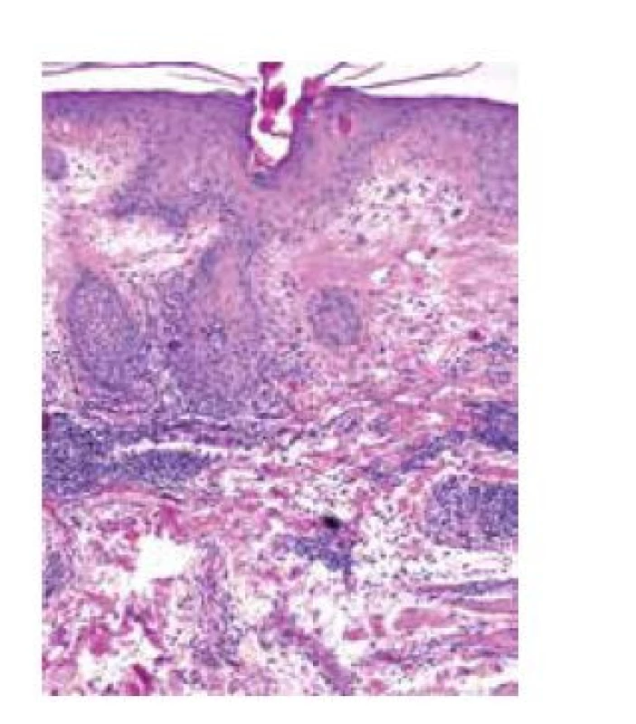 a. Histopatologické vyšetření s folikulárně akcentovanou
hyperkeratózou, výrazným zesílením bazální membrány
epidermis a denzními lymfocytárními perivaskulárními
a periadnexálními infiltráty (HE, 100x)