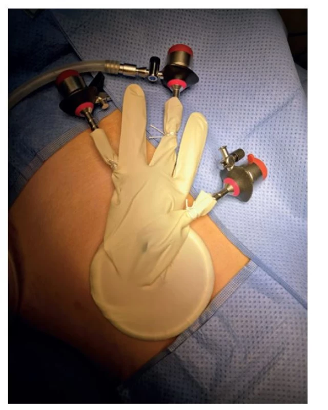 Standardní 5 mm laparoskopické porty fixované
v prstech rukavice<br>
Fig. 3: Standard 5 mm laparoscopic ports fixed in the fingers
of the glove