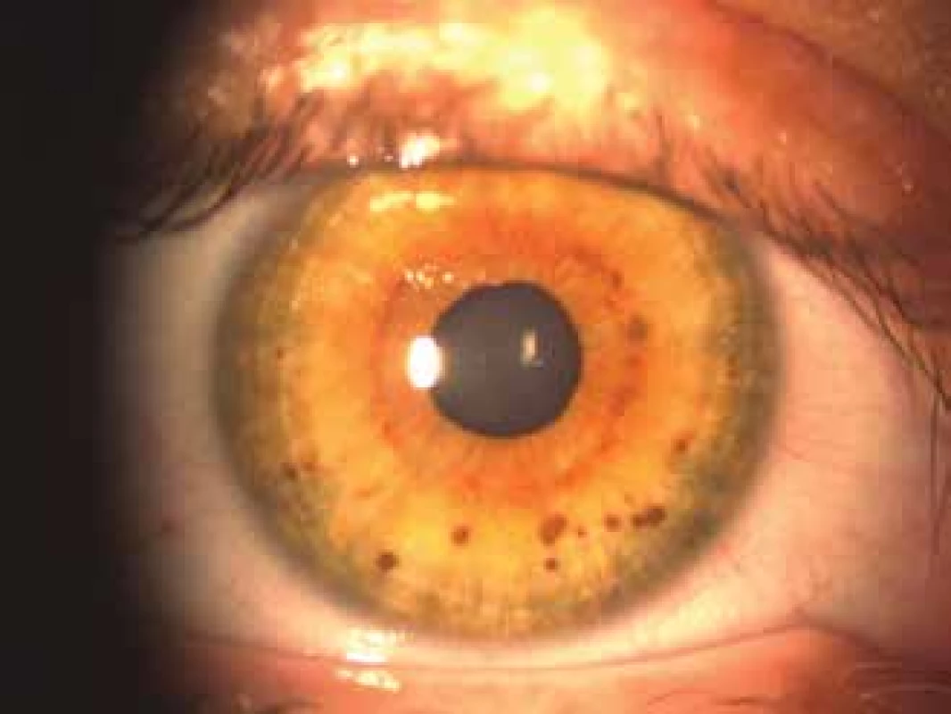 Lisch nodules<br>
Source: Children’s Ophthalmology Clinic, Faculty of Medicine,
Masaryk University and University Hospital Brno