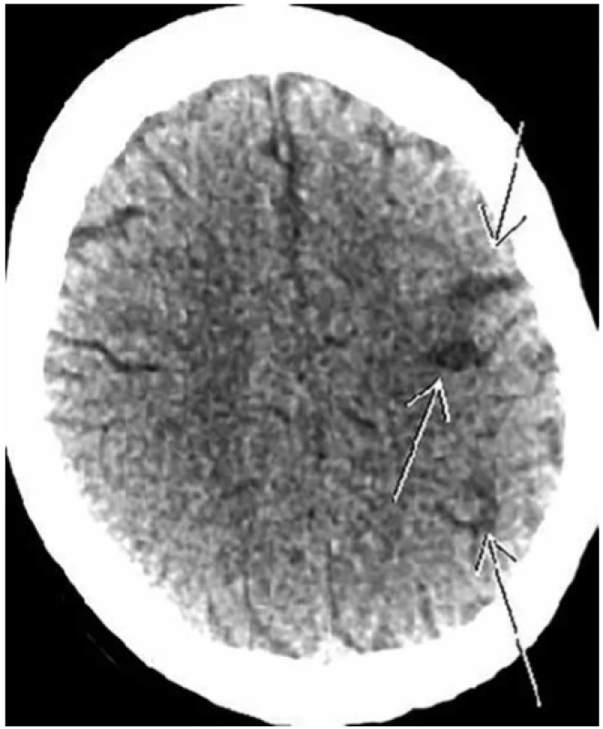 Nevelké postmalatické změny v levé mozkové hemisféře <br>
Fig. 7. Minor postmalatic changes in the left cerebral hemisphere 

