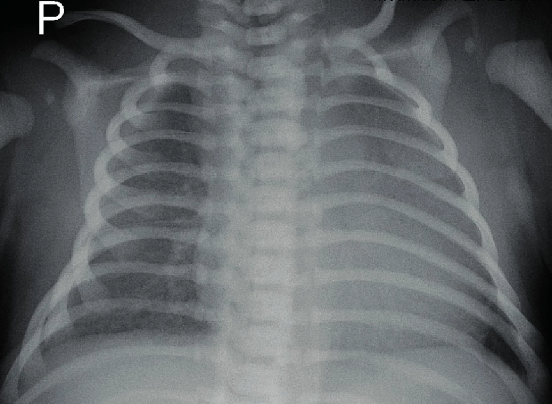 Rentgen hrudníku – zastření levého středního plicního
pole při aspiraci plodové vody.<br>
Fig. 1. X-ray of the chest – diffuse haziness of the left middle
lung field.