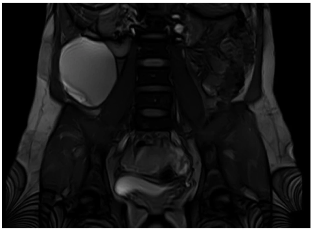 MRI břicha, koronární řez <br>
Jedna z porcí cystické expanze v intimním vztahu k pravé ledvině. <br>
Fig. 3: Abdominal MRI, coronary view <br>
Part of the cystic expansion in close relationship with the right kidney.