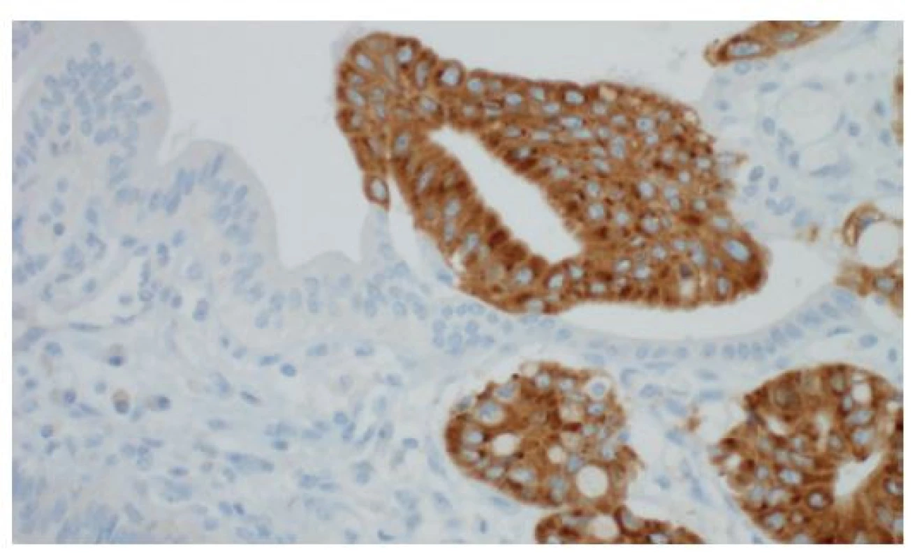 Imunohistochemická pozitivita insulin-like messenger
RNA binding protein 3 (IMP3) v těžké biliární
dysplazii (vpravo), normální epitel (vlevo) je negativní,
imunohistochemie, 400×<br>
Fig. 7: Positive finding of the insulin-like messenger RNA
binding protein 3 (IMP3) based on immunohistochemistry
in a high-grade biliary dysplasia (on the right); negative
finding in the non-neoplastic epithelium (on the left);
immunohistochemistry, 400×