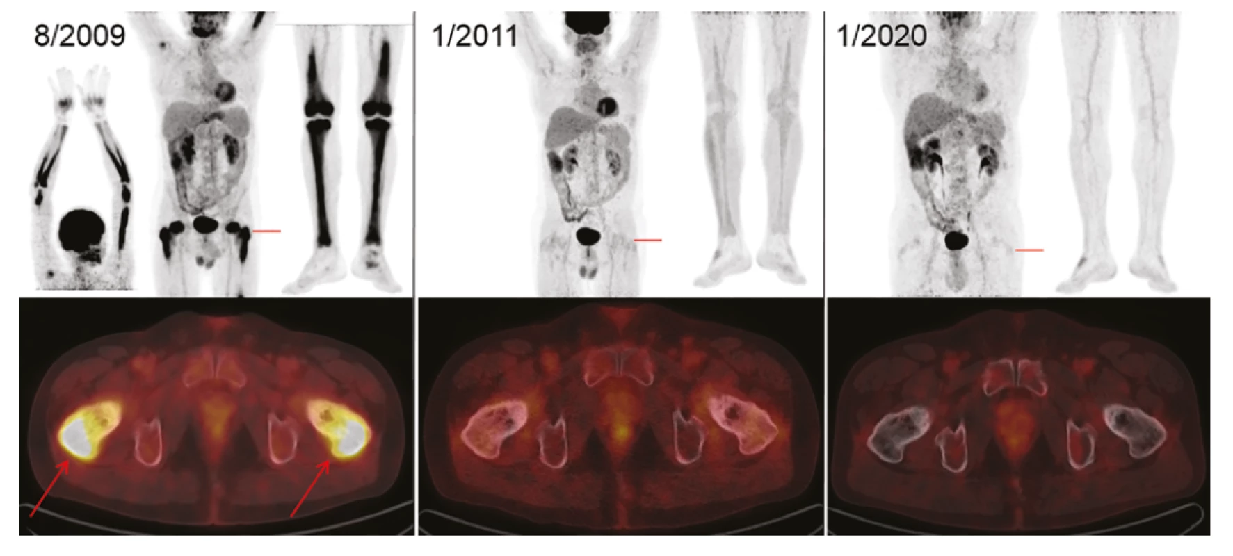 Zobrazení nemoci pomocí FDG-PET/CT vyšetření: Vlevo iniciální sken s MIP projekcí trupu, horních i dolních končetin (v černobílé barevné škále).
Červeně označené místo axiálního fúzovaného řezu (v barevné škále Hot Body) s maximem FDG-avidního postižení proximálních stehenních kostí (šipky)
v korelaci se skleroticko-lytickou strukturou kosti. Uprostřed obraz svědčící pro remisi – vymizení patologických akumulací FDG ve skeletu horních i dolních
končetin. Tento stav trvá i po 9 letech, což dokumentují identické obrázky vpravo. Akumulace FDG v mozku, ledvinách, močovém měchýři je fyziologická.
Akumulace v myokardu, ve vzestupném tračníku v rámci variant fyziologického zobrazení