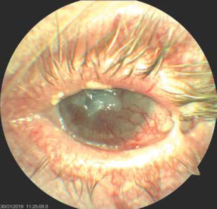 Left eye of patient – incipient lysis of corneal leucoma,
condition after partial tarsorrhaphy, eye irritated
