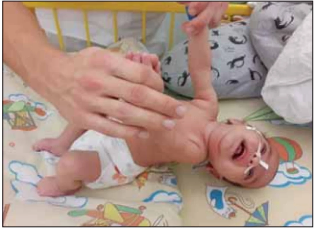 Těžká hypotonie u kojence se SMA I.<br>
Fig. 1. Severe hypotonia in an infant with SMA I