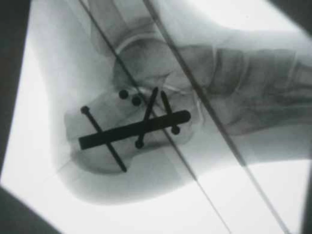 Final radiograph after osteosynthesis