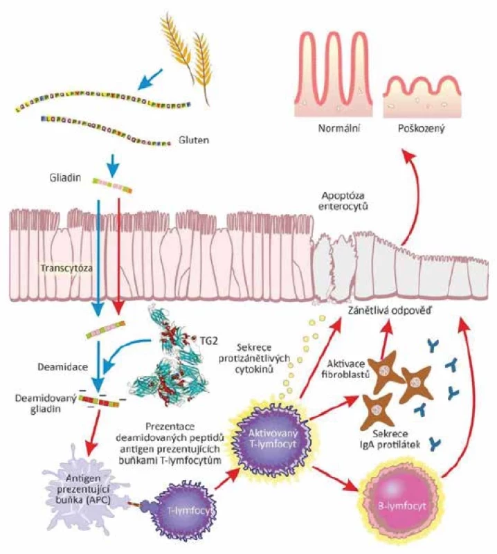 Mechanismus rozvoje celiakie</br>Figure 1. Pathogenetic mechanism of celiac disease