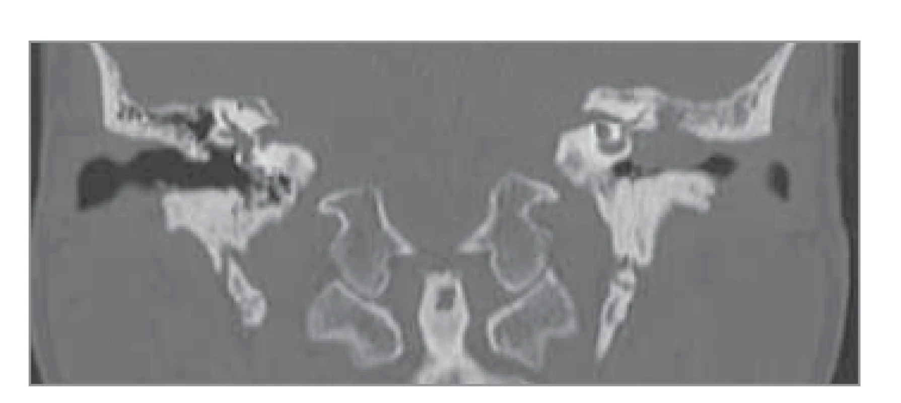 HRCT pyramid, koronární
řez: levé středouší vyplněné tumorózní
masou propagující se směrem
do zevního zvukovodu, bubínek je
intaktní, kůstky jsou destruovány.
Tumor se nešíří do mastoidního výběžku,
ale vyplňuje jej tekutina. Skutum
je destruováno.<br>
Fig. 3. HRCT pyramid, coronal plane:
left middle ear filled with tumorous
mass bulging towards the external auditory
canal, tympanic membrane is intact,
ossicles are destroyed. The tumor
does not spread to the mastoid process,
but is filled with fluid. The scutum
is destroyed.