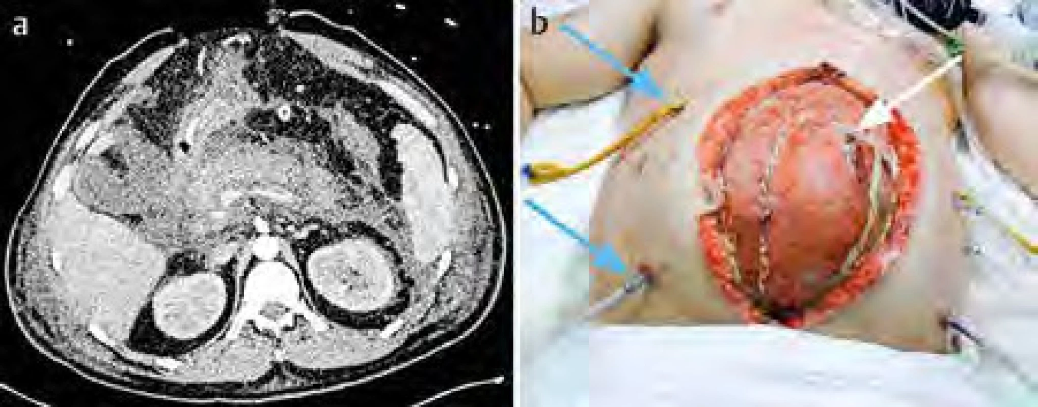  a) CT vyšetření u těžké akutní pankreatitidy zaměřené na okrsky nekróz; b) chirurgicky provedená
laparostomická dekomprese (bílá šipka ukazuje na vloženou síťku, modré šipky ukazují na proplachovací drény)